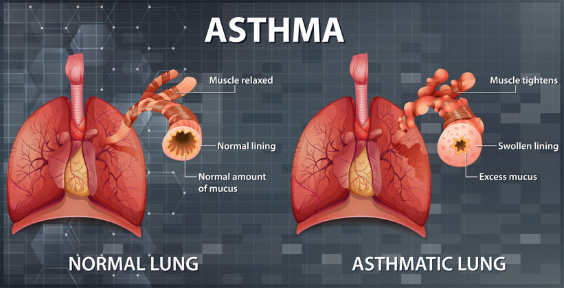 解剖学健康肺与哮喘肺的比较比较人类医学