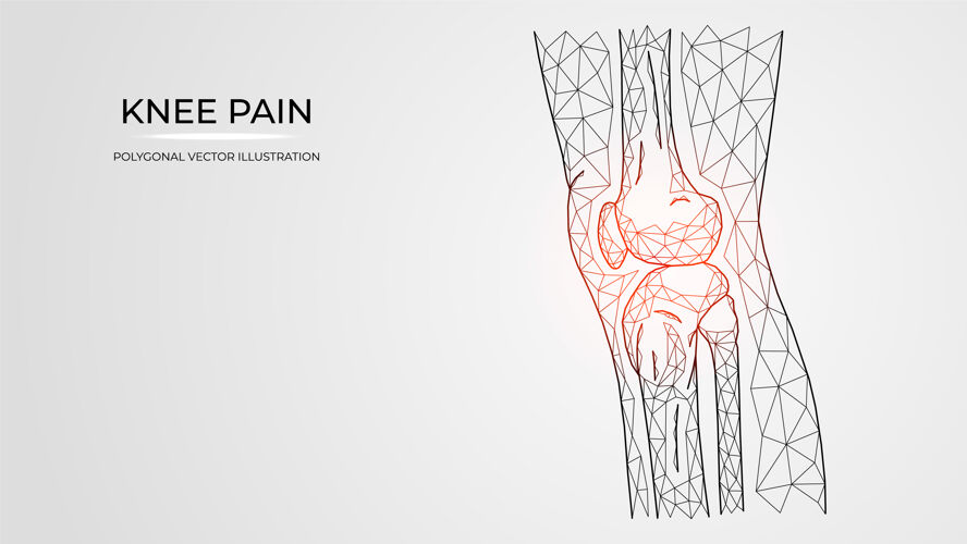 疾病膝侧疼痛 炎症或损伤的多边形矢量图视图.人腿骨解剖身体损伤疼痛