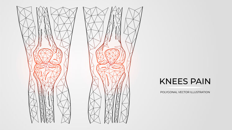 膝盖疼痛 炎症或损伤的多边形矢量图膝盖人类腿骨解剖身体腿疼痛