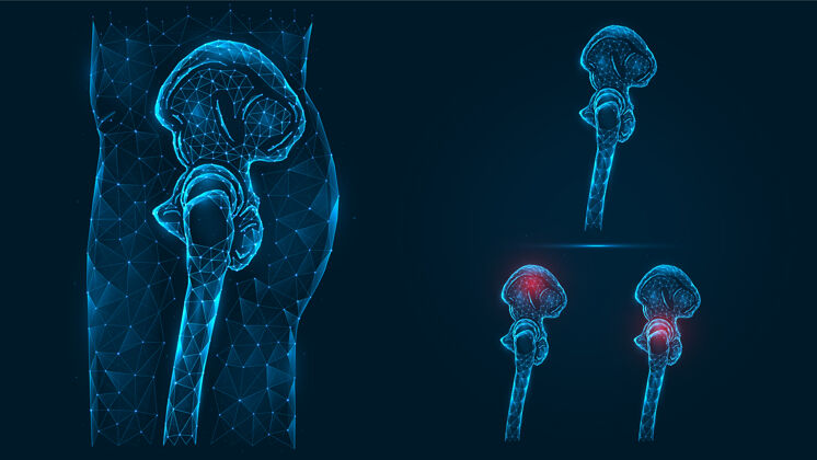 身体人体骨盆和髋骨侧面的多边形图解视图.疾病骨盆和髋关节的疼痛和炎症疾病模型结构