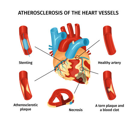 血管动脉粥样硬化的心脏血管平面信息图与标签部分标签零件平