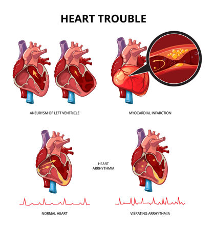 心脏病学心脏病矢量信息图医学人体心脏信息图信息插图心跳疾病信息图