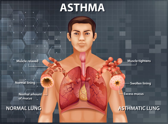 科学健康肺与哮喘肺的比较健康卡通解剖学